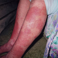 rash on legs, bathing in tap water