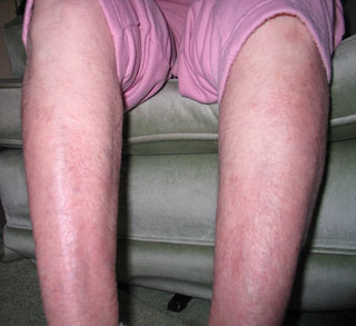 legs after avoiding tap water