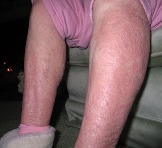 legs after avoiding tap water